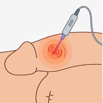 조루 고주파 치료 과정03