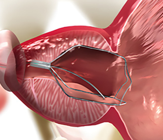 아이틴드 시술과정02